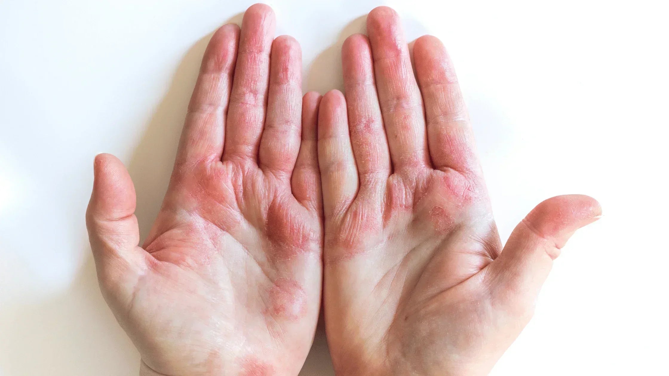 Eczema Creams Only Help Temporarily? Here's the Part Most People Miss